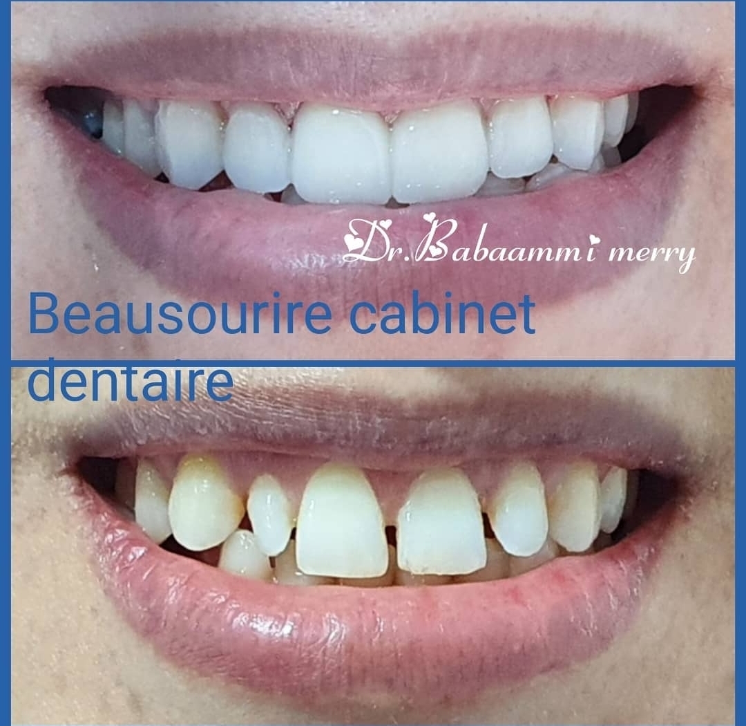 Réalignement esthétique — Fermeture des espaces & harmonisation du sourire