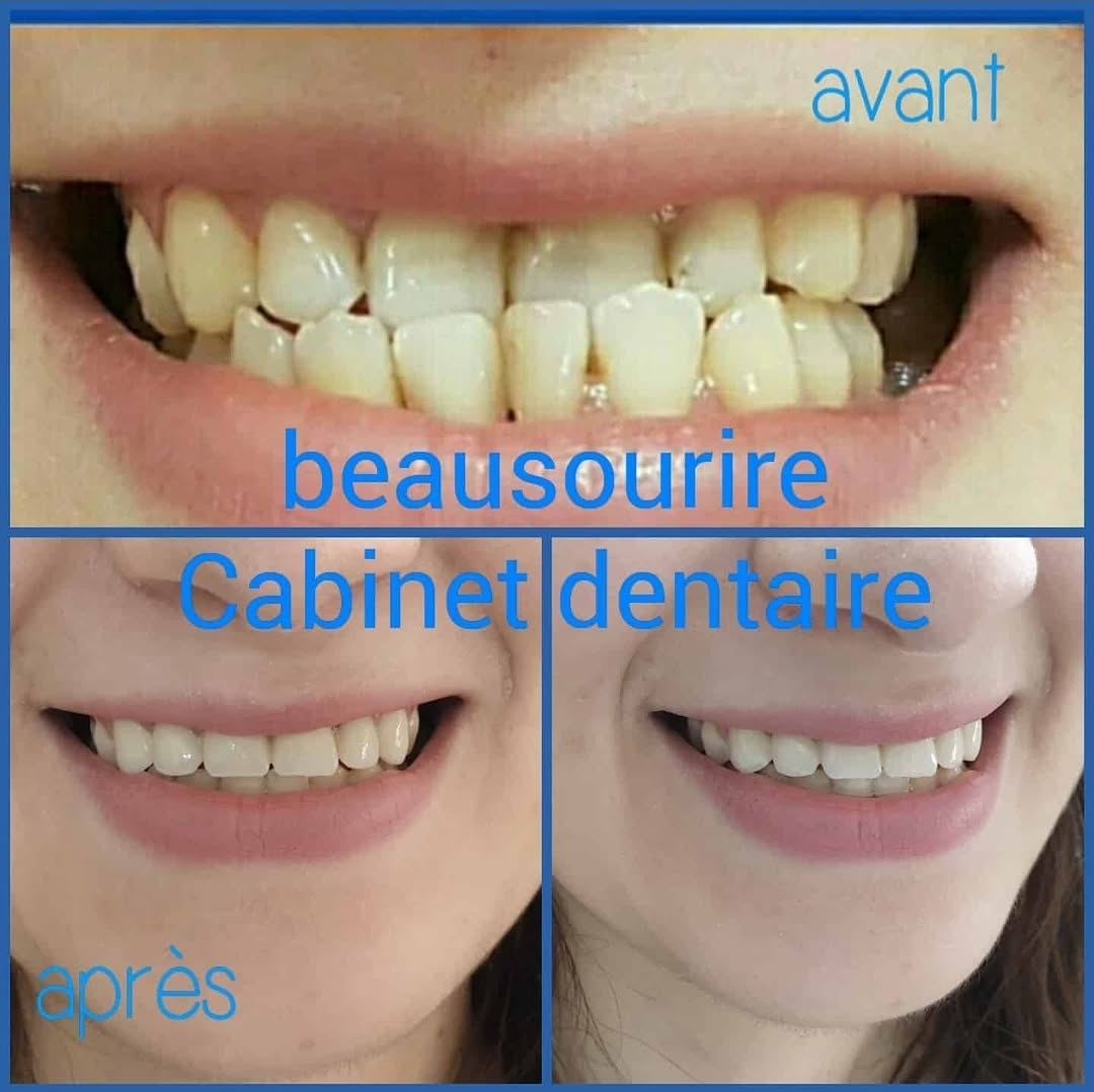 Alignement discret — Correction orthodontique sans bagues visibles